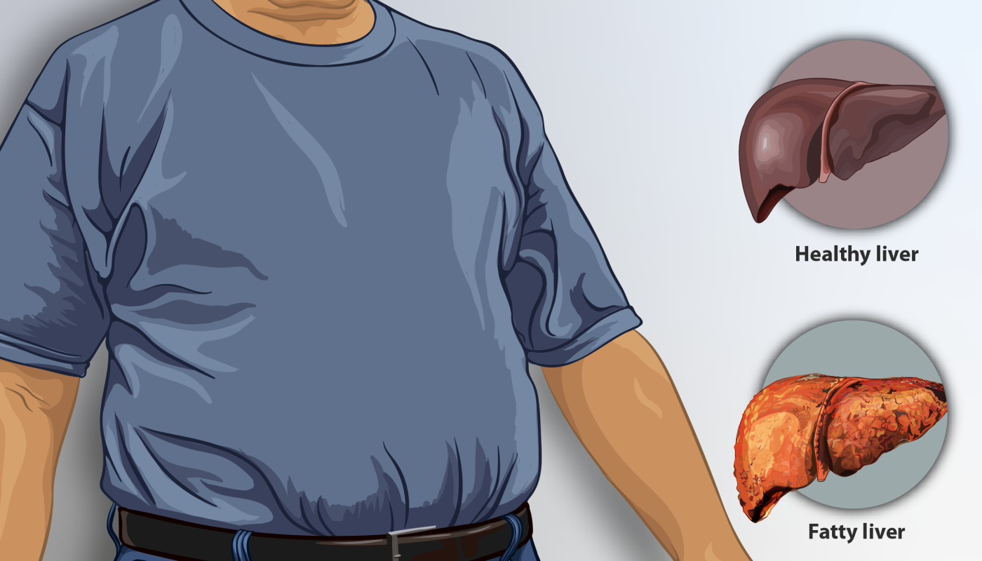 Fatty Liver Disease