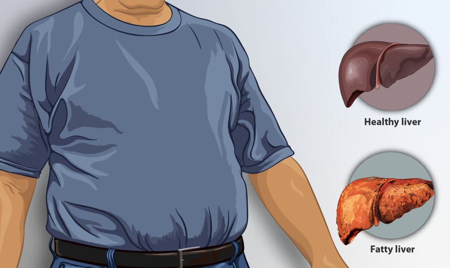 What Is Fatty Liver Disease? Understanding NAFLD, NASH, MASLD, and MASH