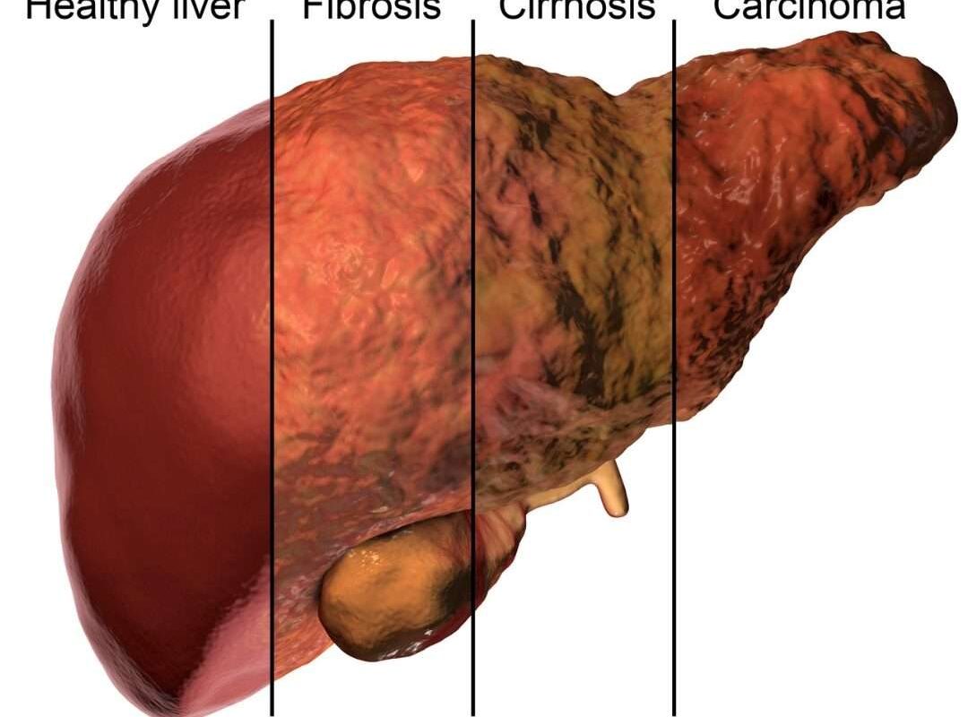 How Fatty Liver Disease Progresses