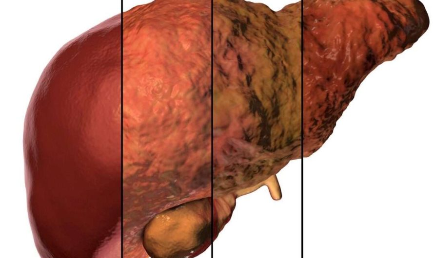 How Fatty Liver Disease Progresses: From Simple Steatosis to Fibrosis and Cirrhosis