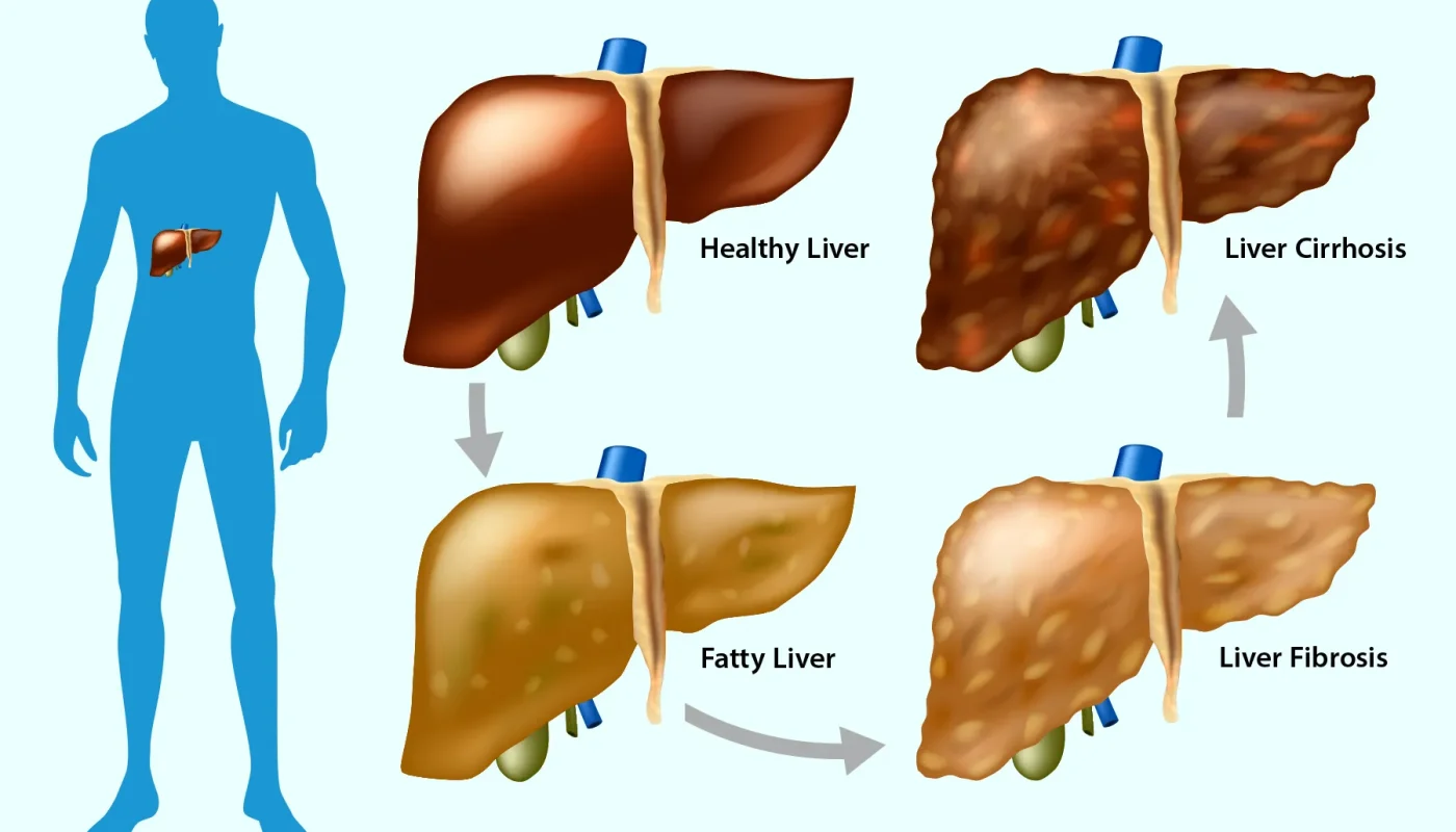 Liver Fibrosis Stages