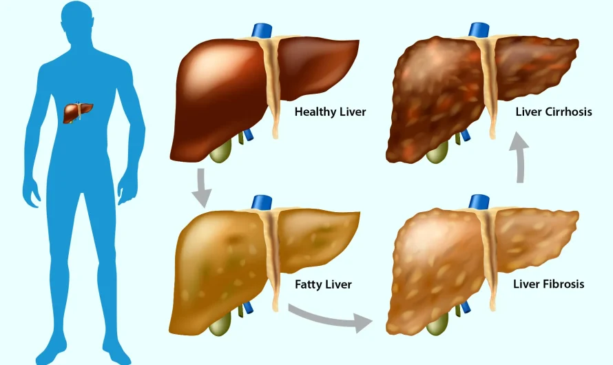 Liver Fibrosis Stages Explained: What F0 to F4 Really Mean